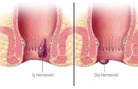 hemoroid türleri
