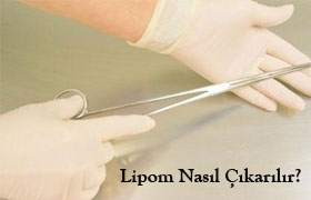 lipom tedavisi nasıl yapılır